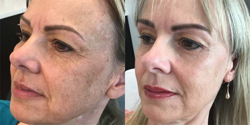 IPL Photofacial Reynolds Plastic Surgery